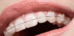 Read more about the article Revolutions In Braces Technology Help Comfort and Aesthetics