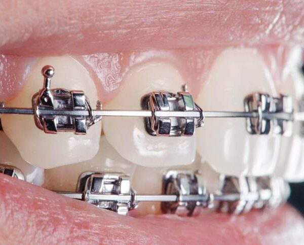 metal braces